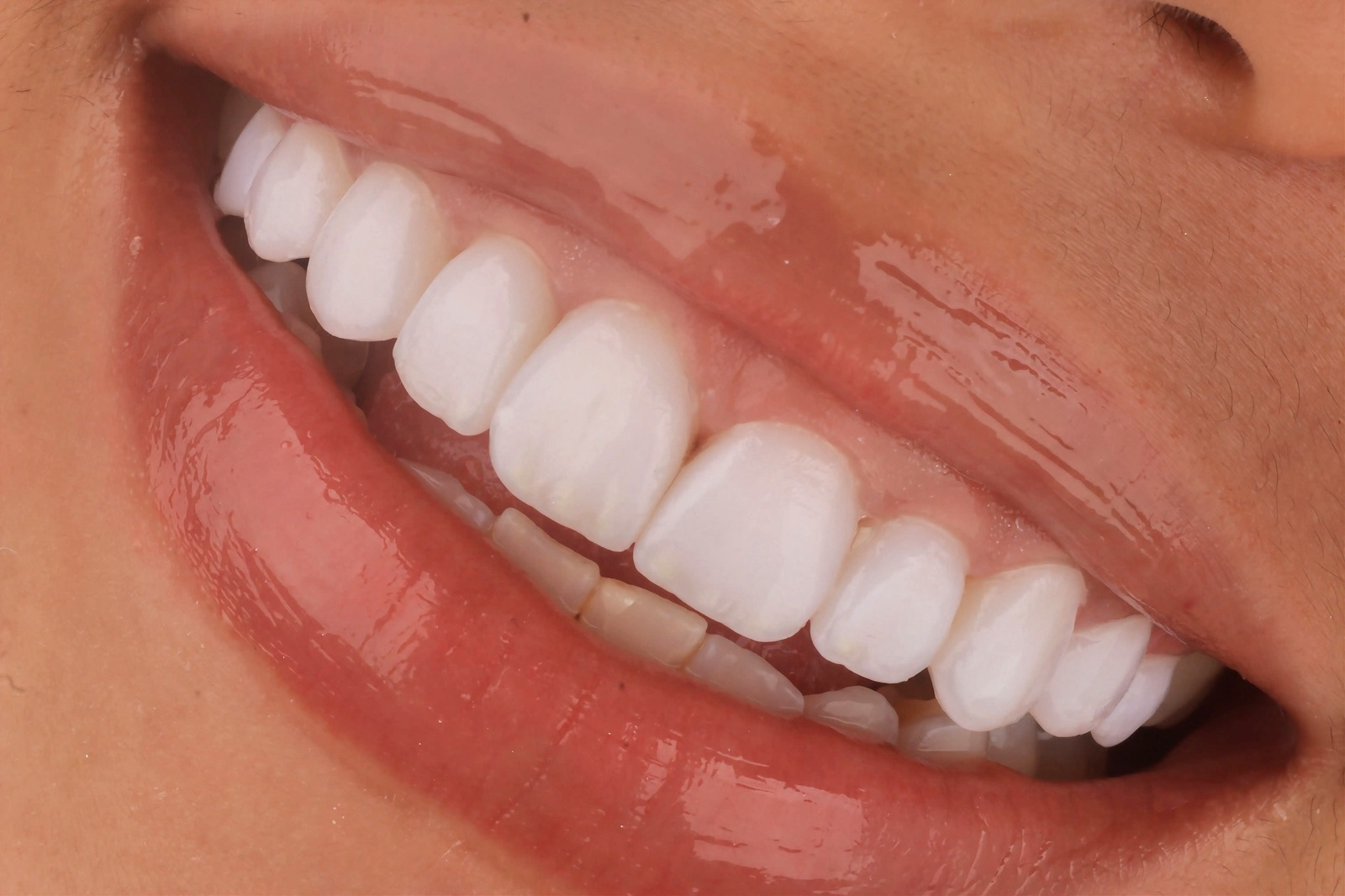 Resultado de tratamiento dental estético
