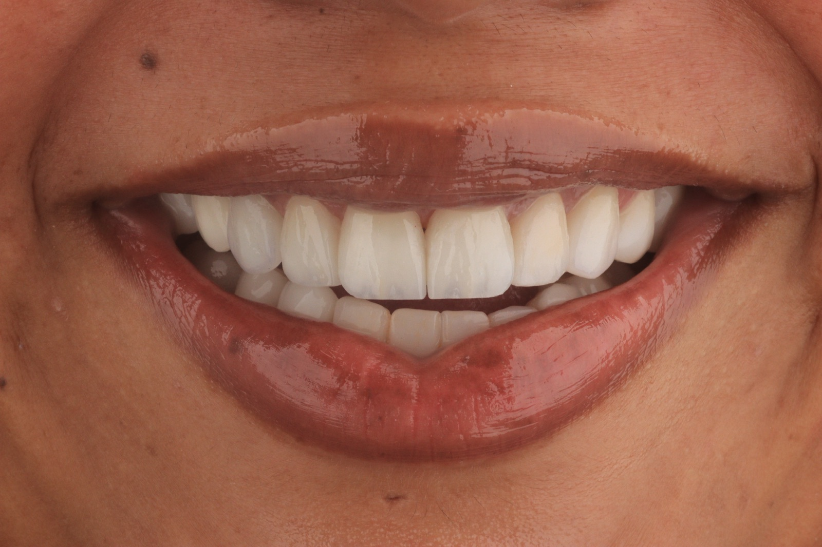 Sonrisa natural y estética
